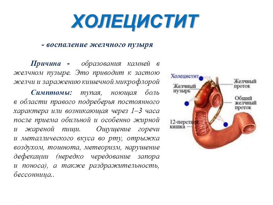 Презентация холецистит терапия