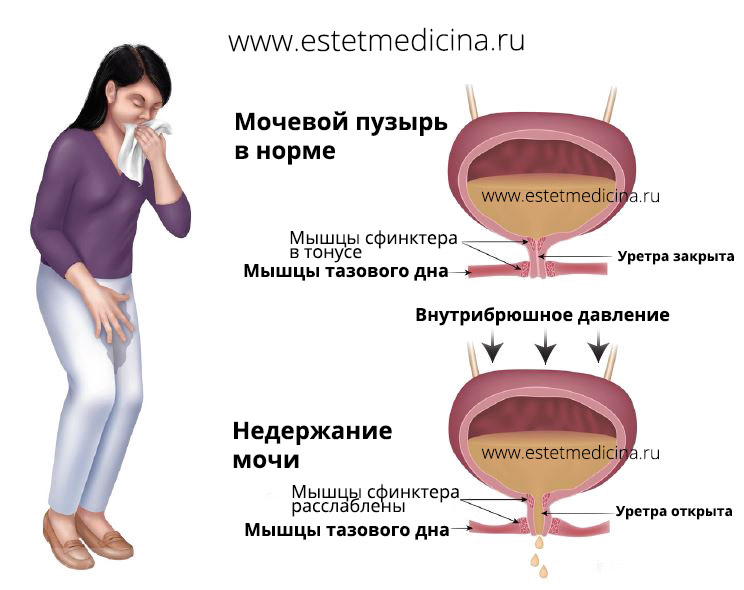 Упражнения от недержания мочи у женщин после 40 лет в картинках