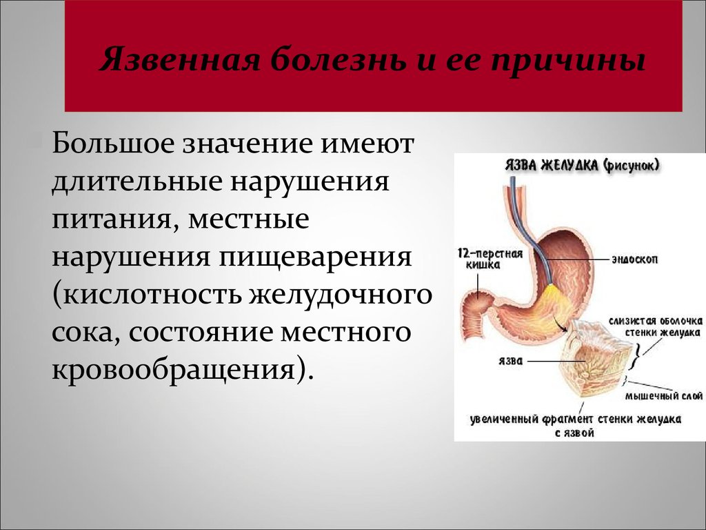 Язва желудка: проявления, методы диагностики и лечение язвенной болезни желудка