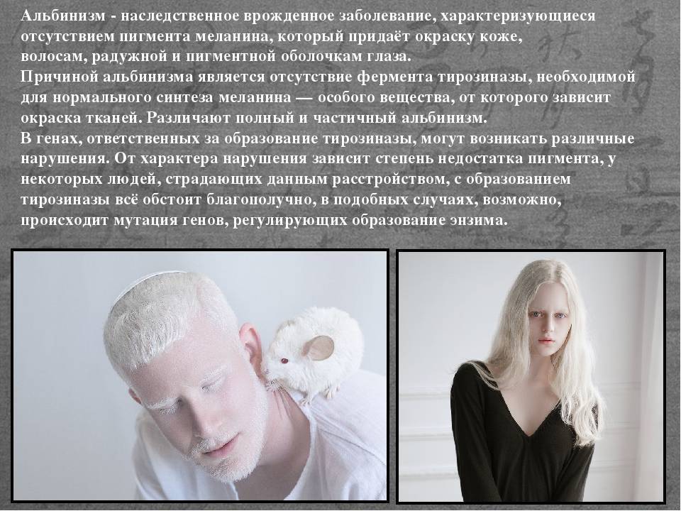 Альбинизм: болезнь альбиносов. Альбинизм генная мутация. Генетические заболевания альбинизм. Альбинизмом страдают