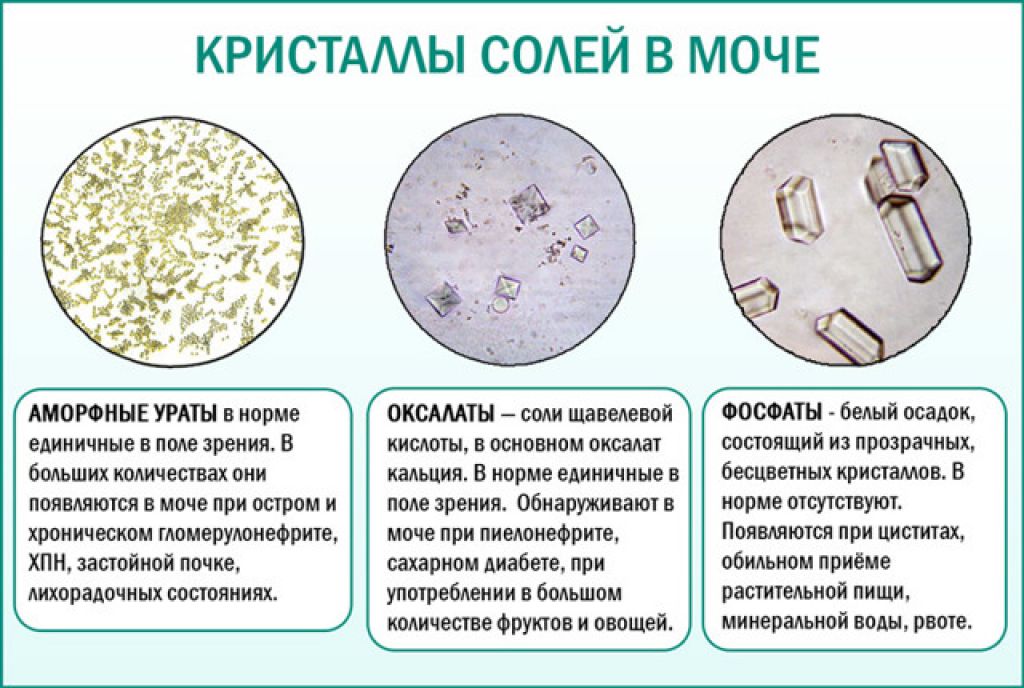 Фосфатные камни в почках и мочевом пузыре: причины, лечение фосфатов, растворение и диета - клиника цкб ран