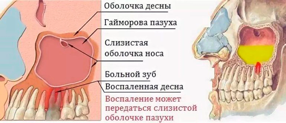 Одонтогенный синусит презентация