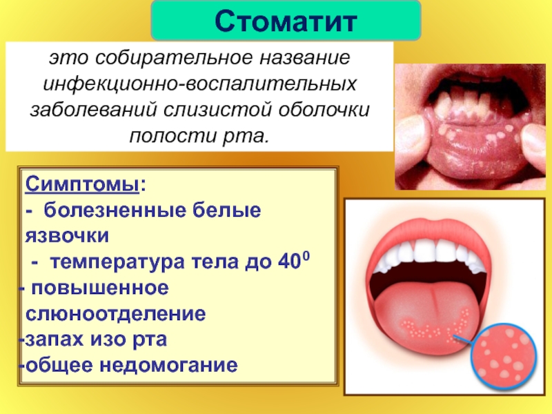 Острый герпетический стоматит у детей презентация