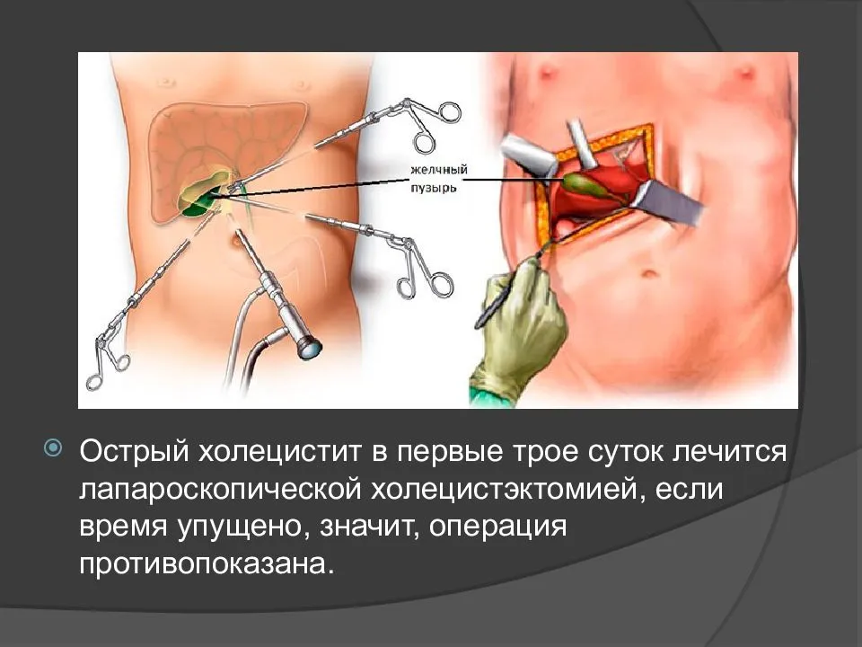 Схема лечения хронического холецистита стадия обострения