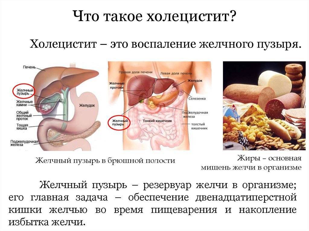 Лечение холецистита схема