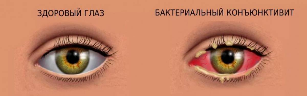 Болезни глаз у шиншиллы: что делать при гноении и слезоточивости, лечение катаракты и конъюнктивита у зверька, от чего воспалился и как лечить каплями