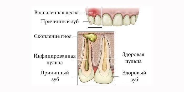 Флюс зуба: причины возникновения, симптоматика и методы лечения - стоматология №1