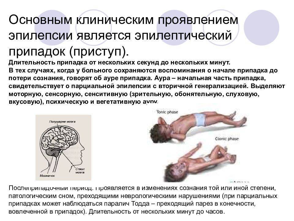 Лечение эпилепсии картинки