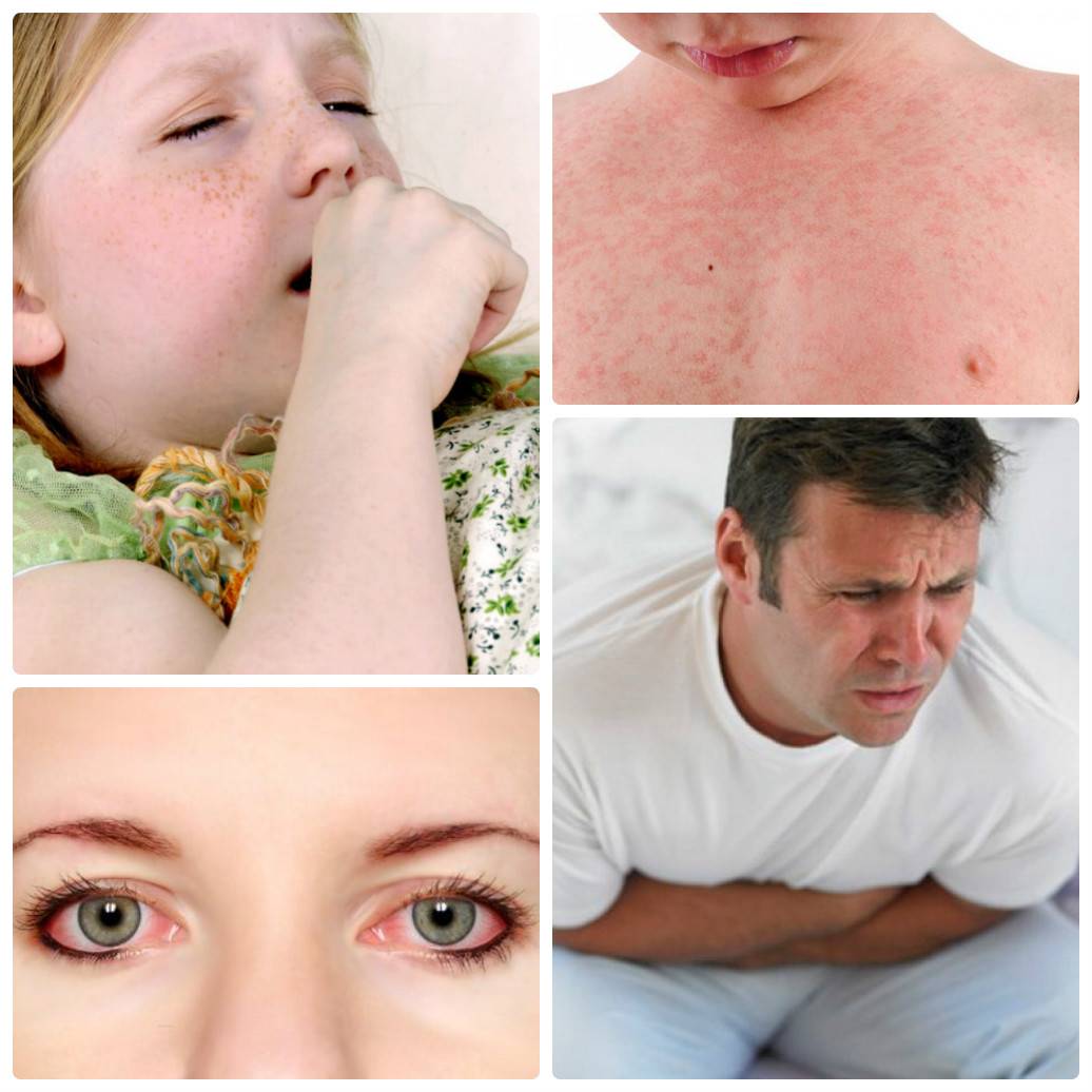 Пищевая аллергия: причины, симптомы, лечение | энтеросгель
