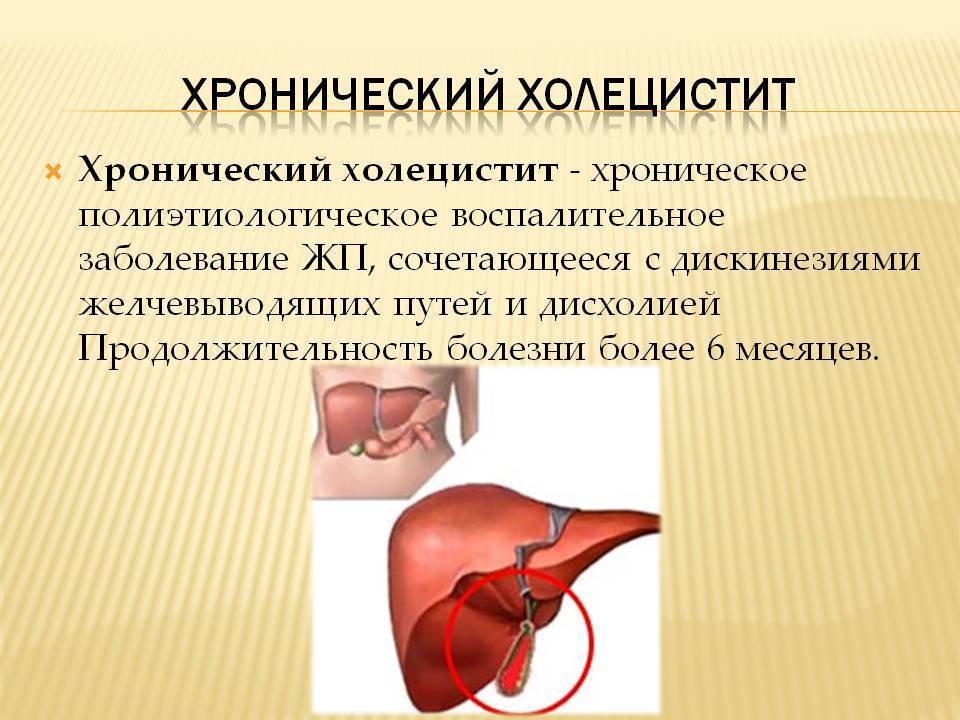 Холецистит