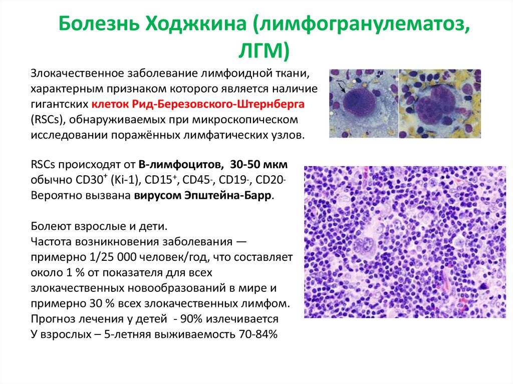 Картина крови при лимфоме