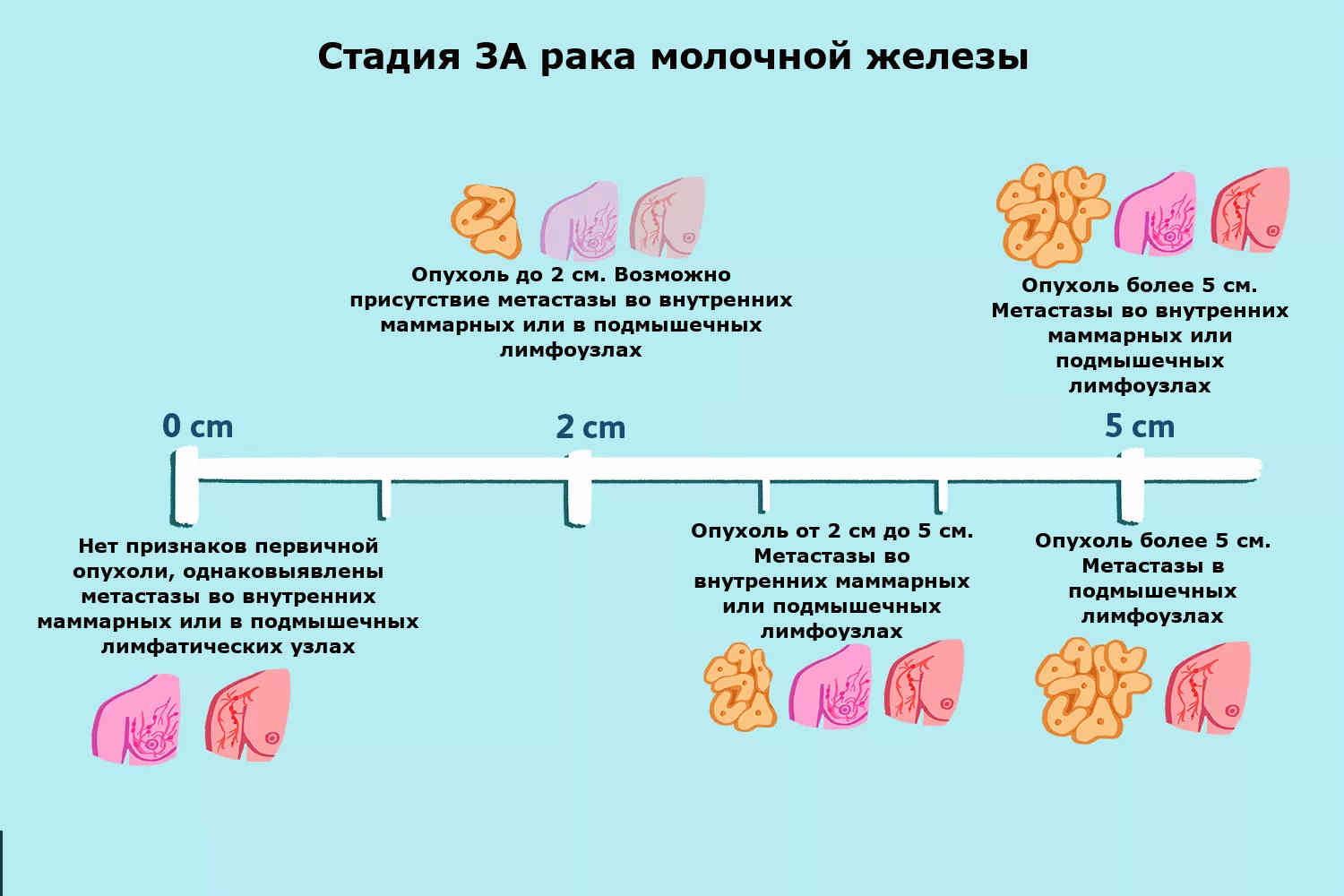 Гинекомастия у мужчин: фото, лечение без операции
