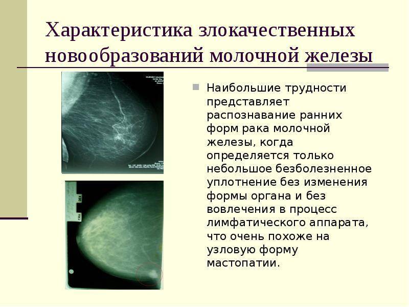 Доброкачественные и злокачественные опухоли молочной железы презентация