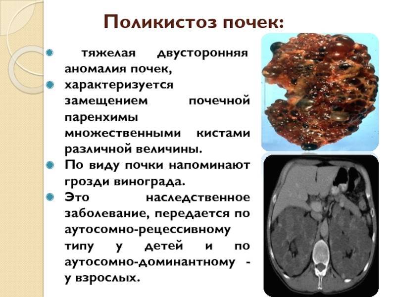 Поликистоз инфильтративного типа мелкокистозного типа дает эхографическую картину