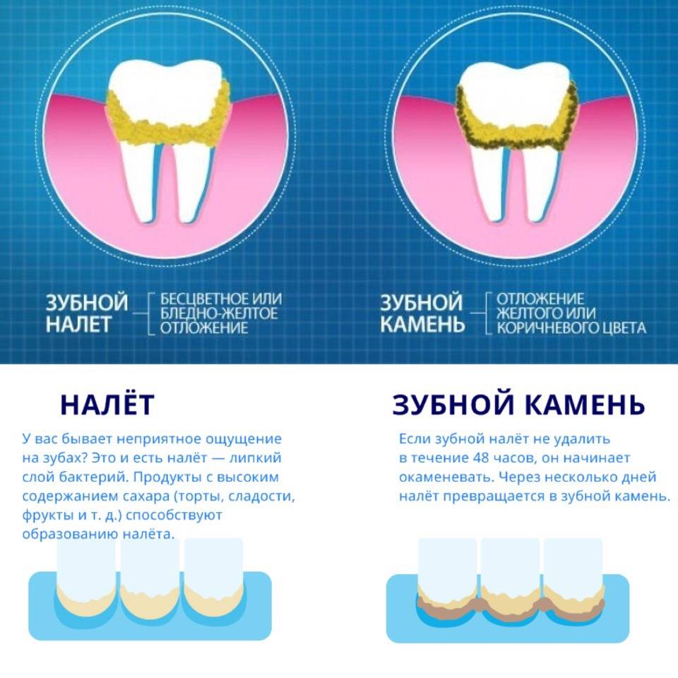 Налет на зубах у взрослых: причины и способы устранения налета