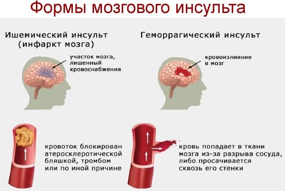 Инсульт головного мозга: причины, симптомы и лечение | ким