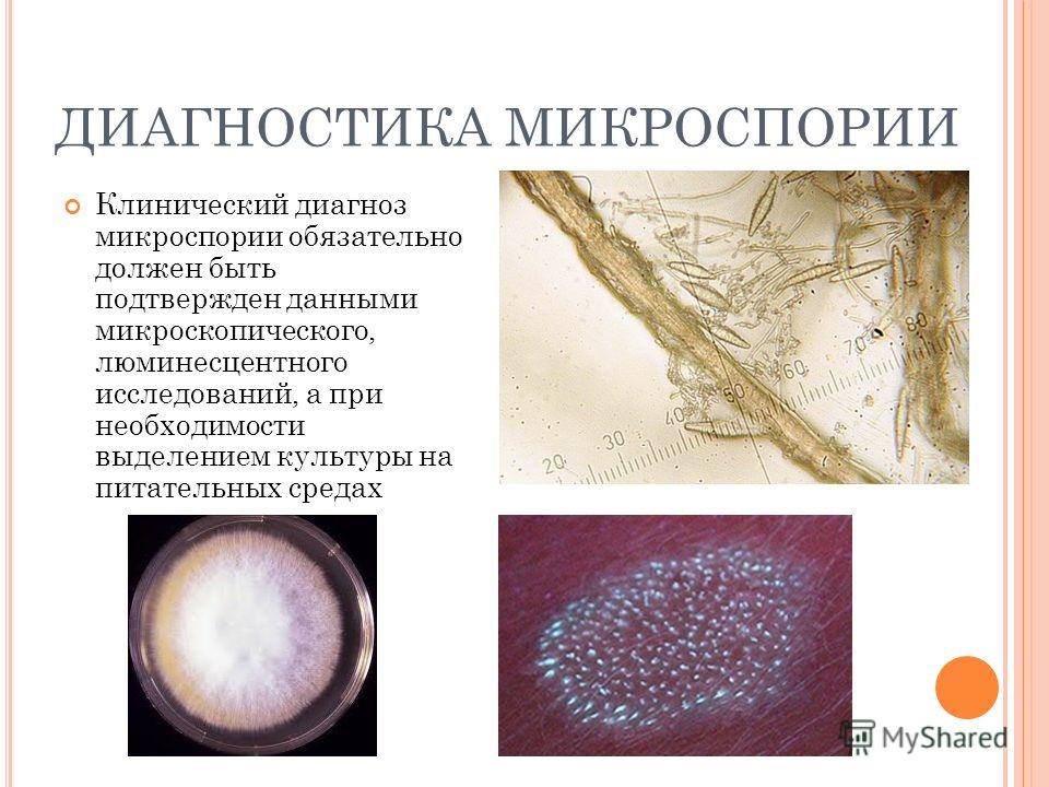 Возбудитель разноцветного лишая. Микроскопия трихофития на гладкой коже. Микроспорум Канис микроскопия. Микроскопия микроспория кожи. Микроскопическое исследование микроспории.