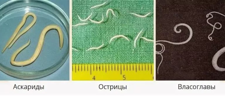 Симптомы и лечение опоясывающего герпеса у взрослых