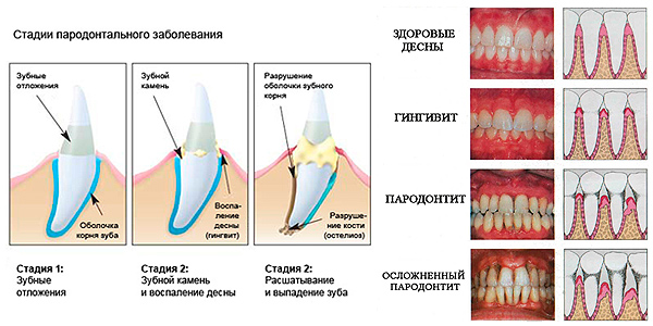 Схема лечения пародонтоза лекарства