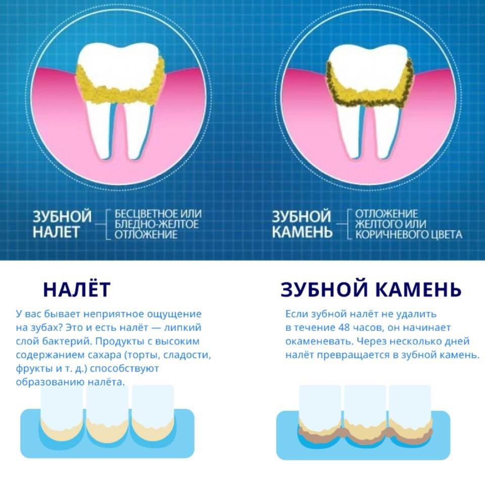 Циркониевые коронки для зубов - преимущества и недостатки