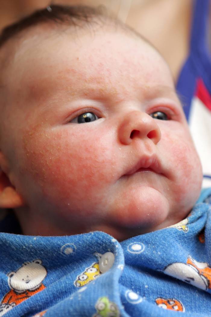 Есть ли аллергия на гречку. Неонатальный пустулез новорожденных. Гнейс атопический дерматит. Везикулопустулез новорожденного.