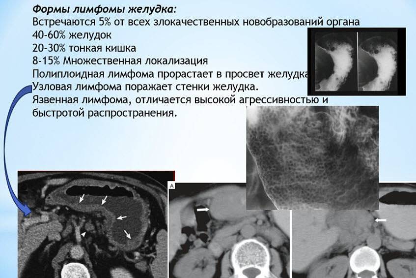 2. Потеря веса